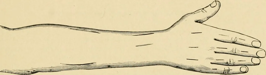 An illustration from The principles and practice of modern surgery / by Roswell Park ... with 722 engravings and 60 full-page plates in colors and monochrome., 1907, leaf 389