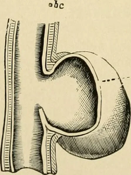 An illustration from The principles and practice of modern surgery / by Roswell Park ... with 722 engravings and 60 full-page plates in colors and monochrome., 1907, leaf 402