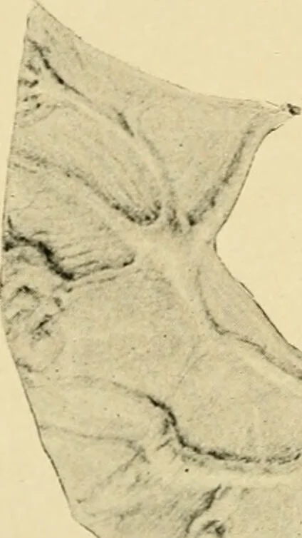 An illustration from The principles and practice of modern surgery / by Roswell Park ... with 722 engravings and 60 full-page plates in colors and monochrome., 1907, leaf 404