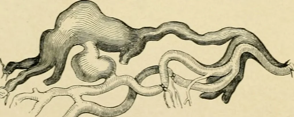 An illustration from The principles and practice of modern surgery / by Roswell Park ... with 722 engravings and 60 full-page plates in colors and monochrome., 1907, leaf 406