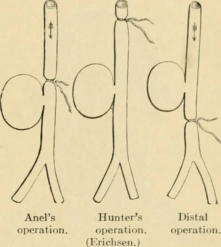An illustration from The principles and practice of modern surgery / by Roswell Park ... with 722 engravings and 60 full-page plates in colors and monochrome., 1907, leaf 409