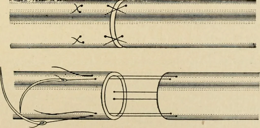 An illustration from The principles and practice of modern surgery / by Roswell Park ... with 722 engravings and 60 full-page plates in colors and monochrome., 1907, leaf 411