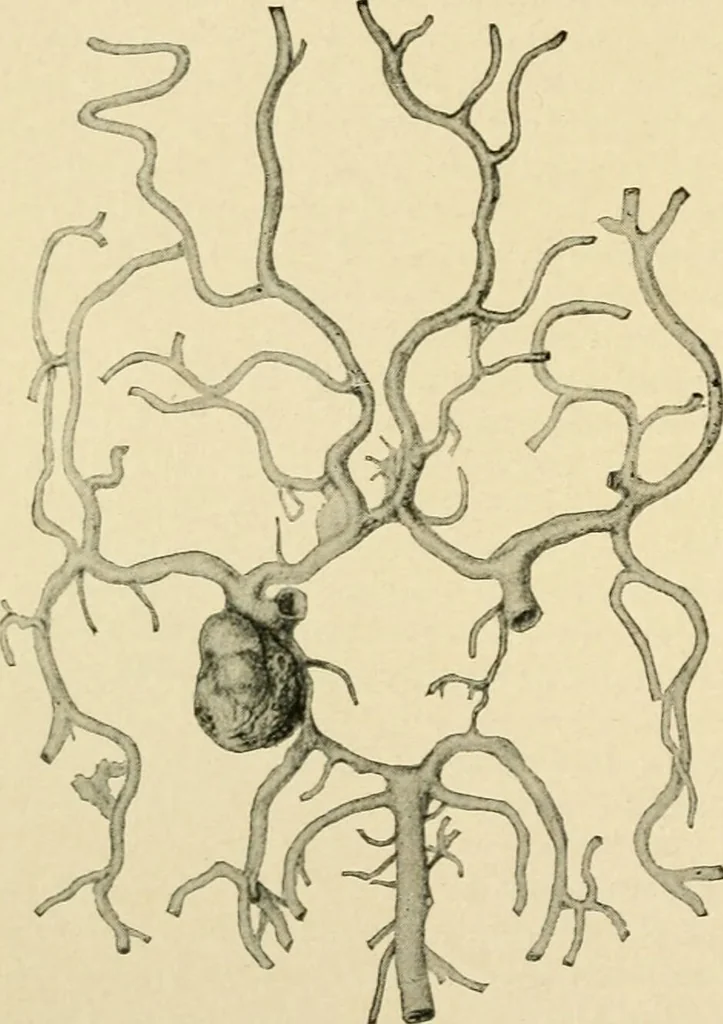 An illustration from The principles and practice of modern surgery / by Roswell Park ... with 722 engravings and 60 full-page plates in colors and monochrome., 1907, leaf 414