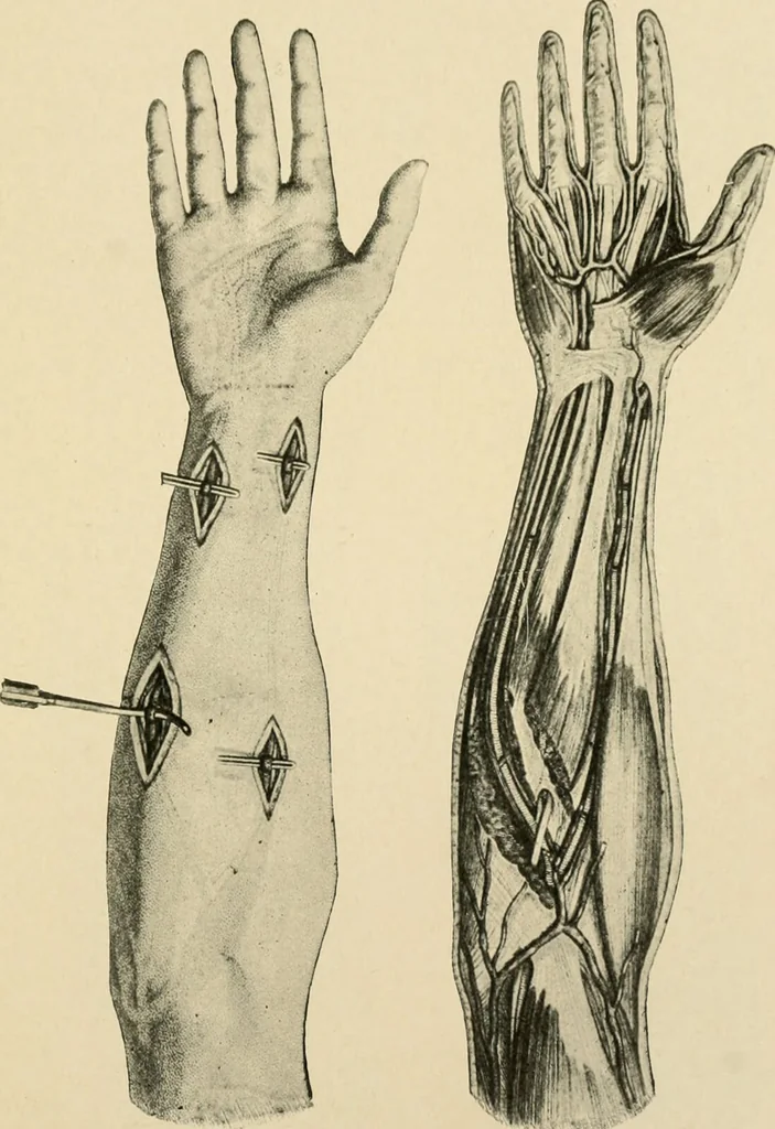 An illustration from The principles and practice of modern surgery / by Roswell Park ... with 722 engravings and 60 full-page plates in colors and monochrome., 1907, leaf 419