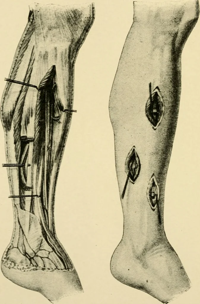 An illustration from The principles and practice of modern surgery / by Roswell Park ... with 722 engravings and 60 full-page plates in colors and monochrome., 1907, leaf 422