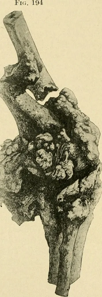 An illustration from The principles and practice of modern surgery / by Roswell Park ... with 722 engravings and 60 full-page plates in colors and monochrome., 1907, leaf 456