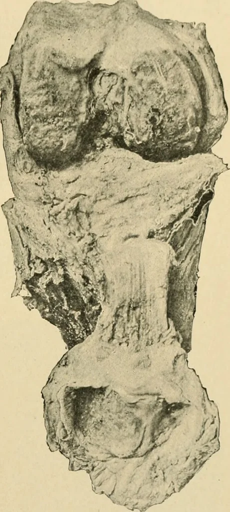 An illustration from The principles and practice of modern surgery / by Roswell Park ... with 722 engravings and 60 full-page plates in colors and monochrome., 1907, leaf 463