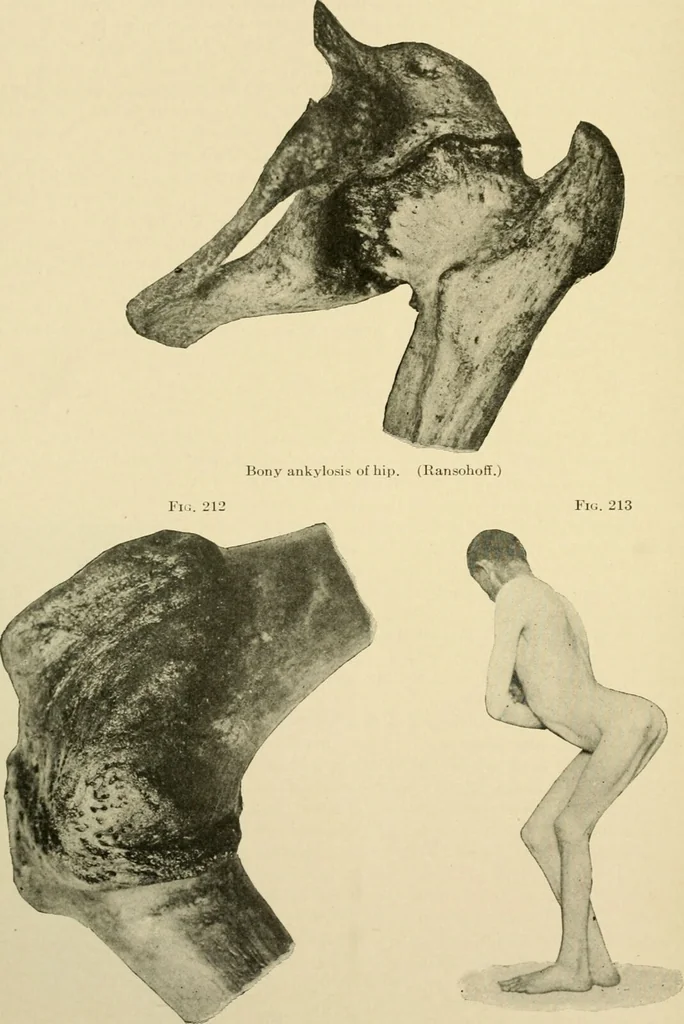 An illustration from The principles and practice of modern surgery / by Roswell Park ... with 722 engravings and 60 full-page plates in colors and monochrome., 1907, leaf 474