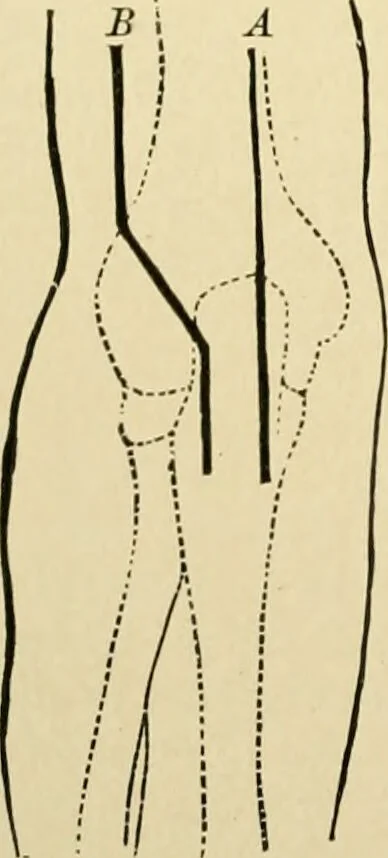 An illustration from The principles and practice of modern surgery / by Roswell Park ... with 722 engravings and 60 full-page plates in colors and monochrome., 1907, leaf 480