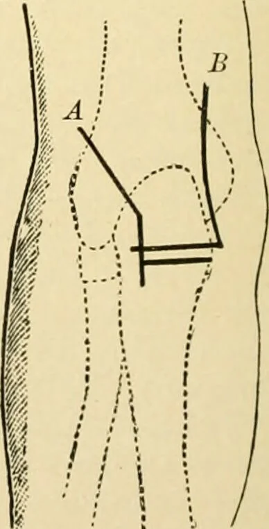 An illustration from The principles and practice of modern surgery / by Roswell Park ... with 722 engravings and 60 full-page plates in colors and monochrome., 1907, leaf 480