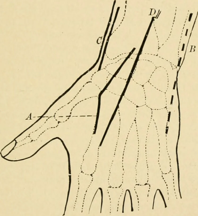 An illustration from The principles and practice of modern surgery / by Roswell Park ... with 722 engravings and 60 full-page plates in colors and monochrome., 1907, leaf 481