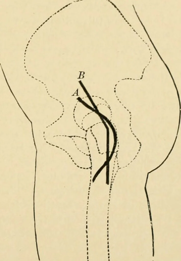 An illustration from The principles and practice of modern surgery / by Roswell Park ... with 722 engravings and 60 full-page plates in colors and monochrome., 1907, leaf 481
