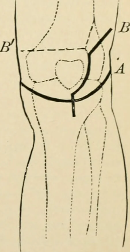 An illustration from The principles and practice of modern surgery / by Roswell Park ... with 722 engravings and 60 full-page plates in colors and monochrome., 1907, leaf 483