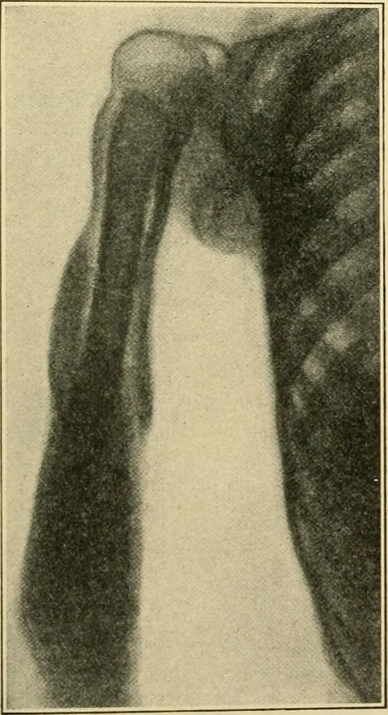 An illustration from The principles and practice of modern surgery / by Roswell Park ... with 722 engravings and 60 full-page plates in colors and monochrome., 1907, leaf 492