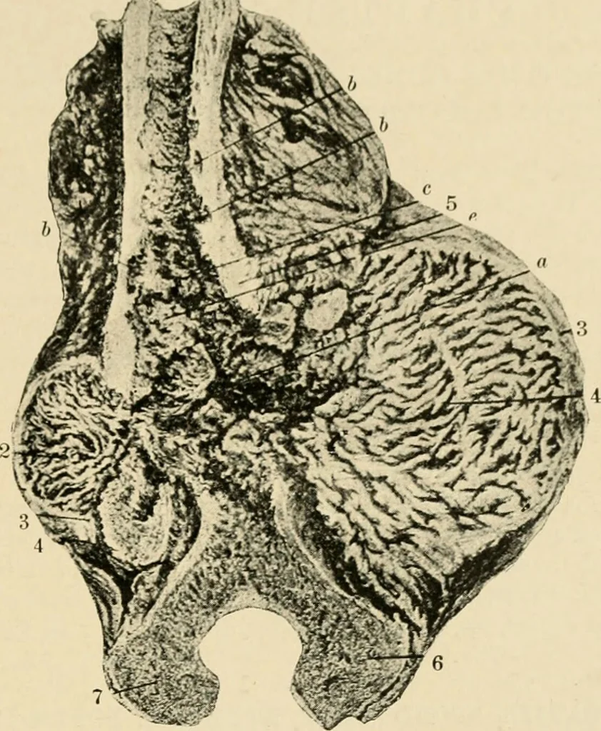 An illustration from The principles and practice of modern surgery / by Roswell Park ... with 722 engravings and 60 full-page plates in colors and monochrome., 1907, leaf 519