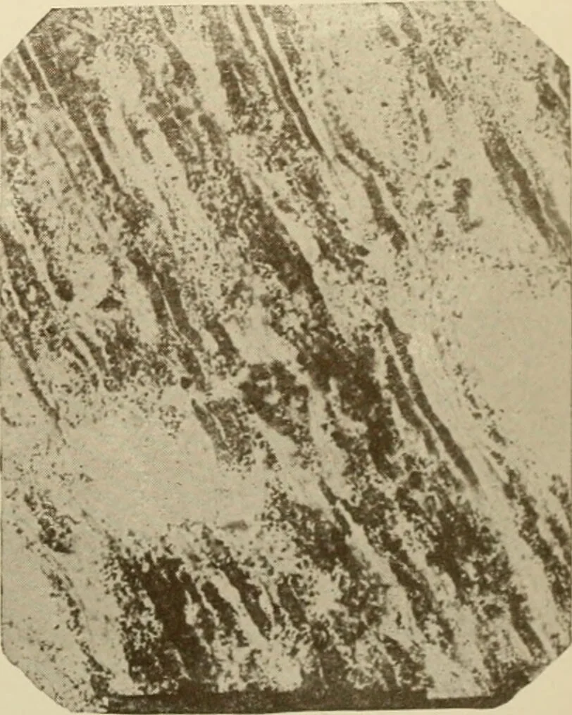 An illustration from The principles and practice of modern surgery / by Roswell Park ... with 722 engravings and 60 full-page plates in colors and monochrome., 1907, leaf 55