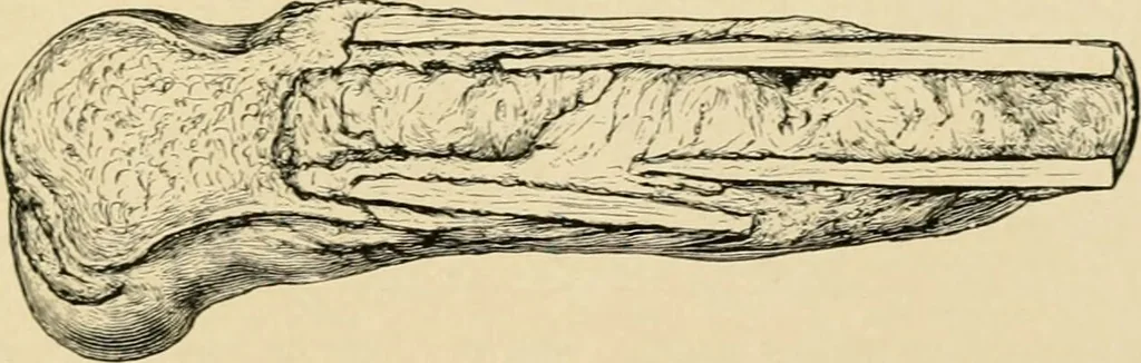 An illustration from The principles and practice of modern surgery / by Roswell Park ... with 722 engravings and 60 full-page plates in colors and monochrome., 1907, leaf 557