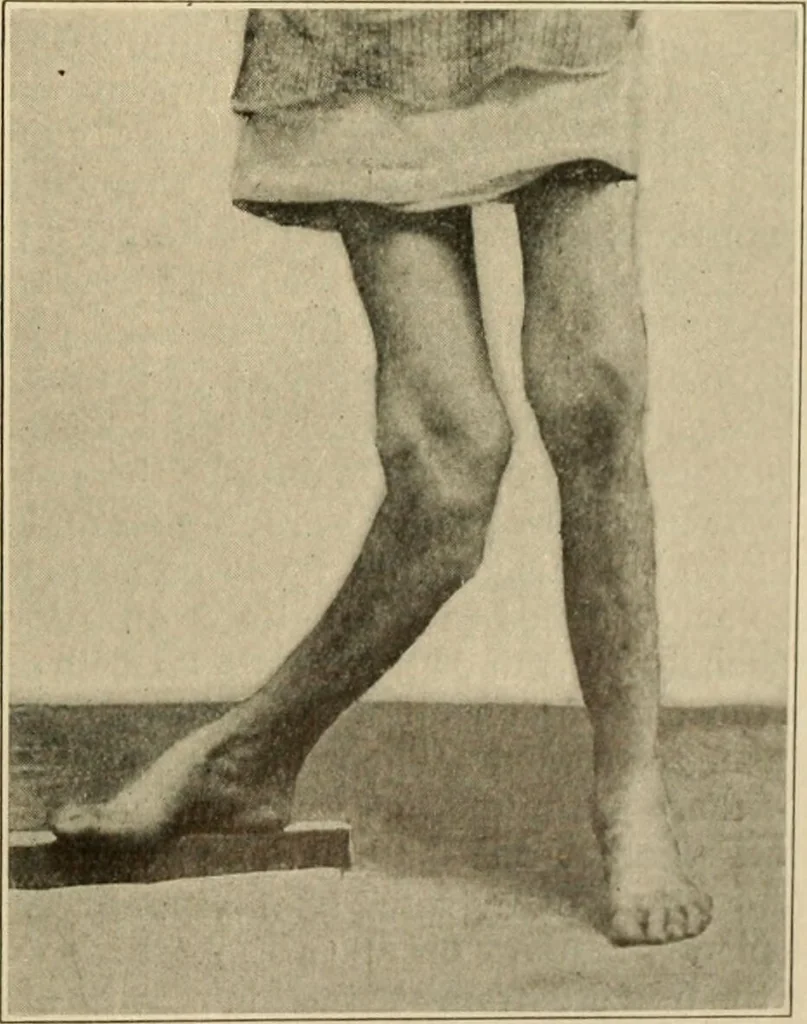 An illustration from The principles and practice of modern surgery / by Roswell Park ... with 722 engravings and 60 full-page plates in colors and monochrome., 1907, leaf 563