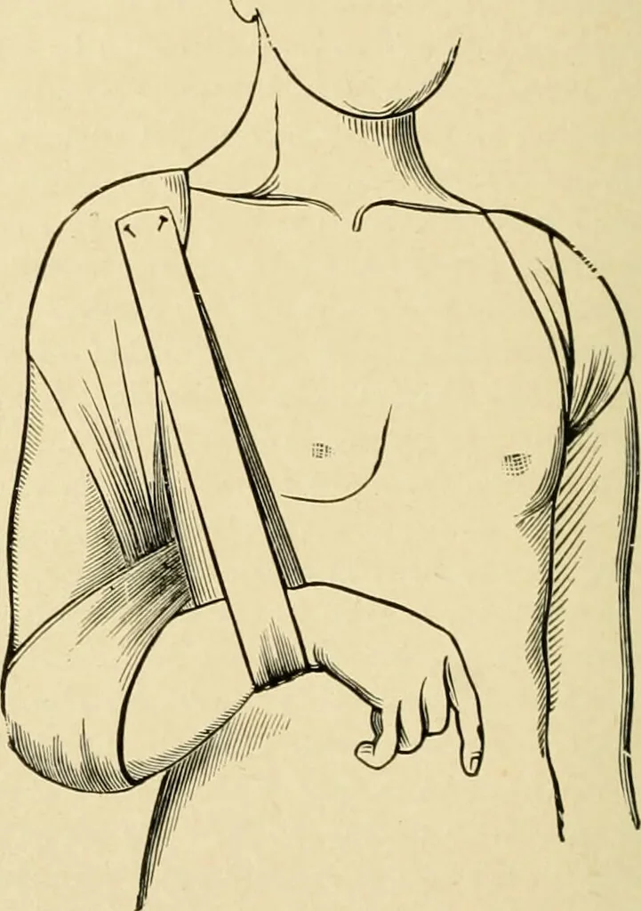 An illustration from The principles and practice of modern surgery / by Roswell Park ... with 722 engravings and 60 full-page plates in colors and monochrome., 1907, leaf 572