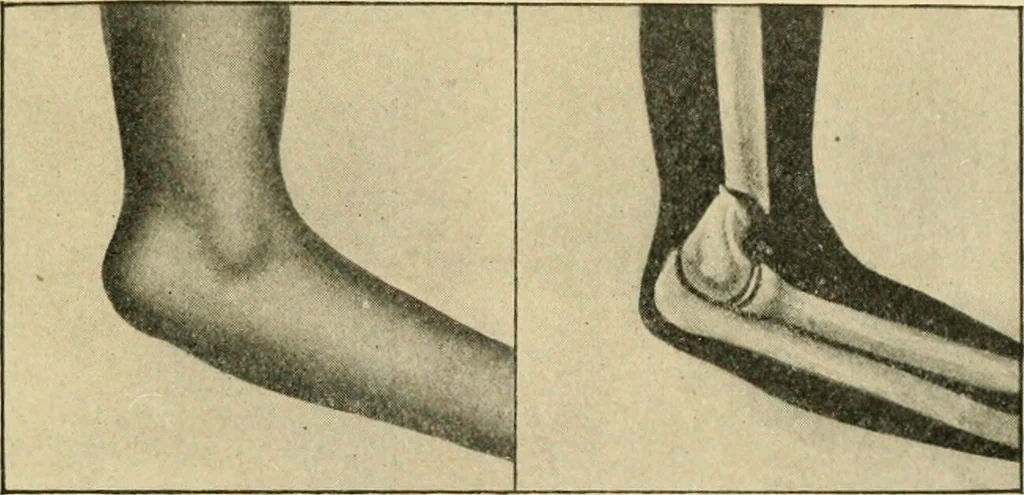 An illustration from The principles and practice of modern surgery / by Roswell Park ... with 722 engravings and 60 full-page plates in colors and monochrome., 1907, leaf 575