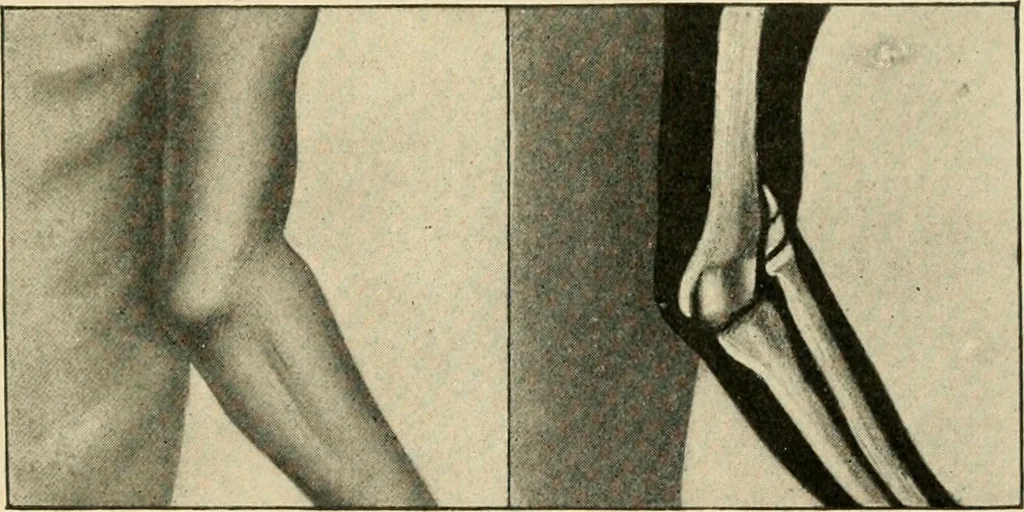 An illustration from The principles and practice of modern surgery / by Roswell Park ... with 722 engravings and 60 full-page plates in colors and monochrome., 1907, leaf 579