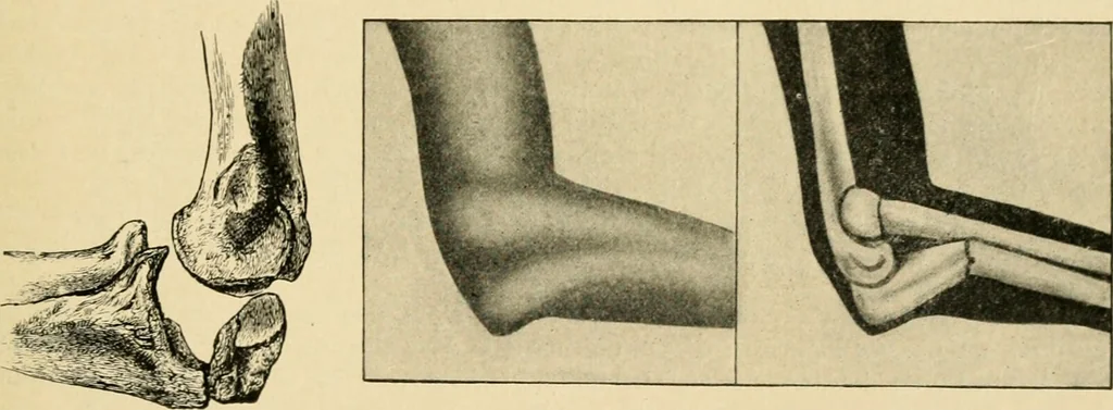 An illustration from The principles and practice of modern surgery / by Roswell Park ... with 722 engravings and 60 full-page plates in colors and monochrome., 1907, leaf 581