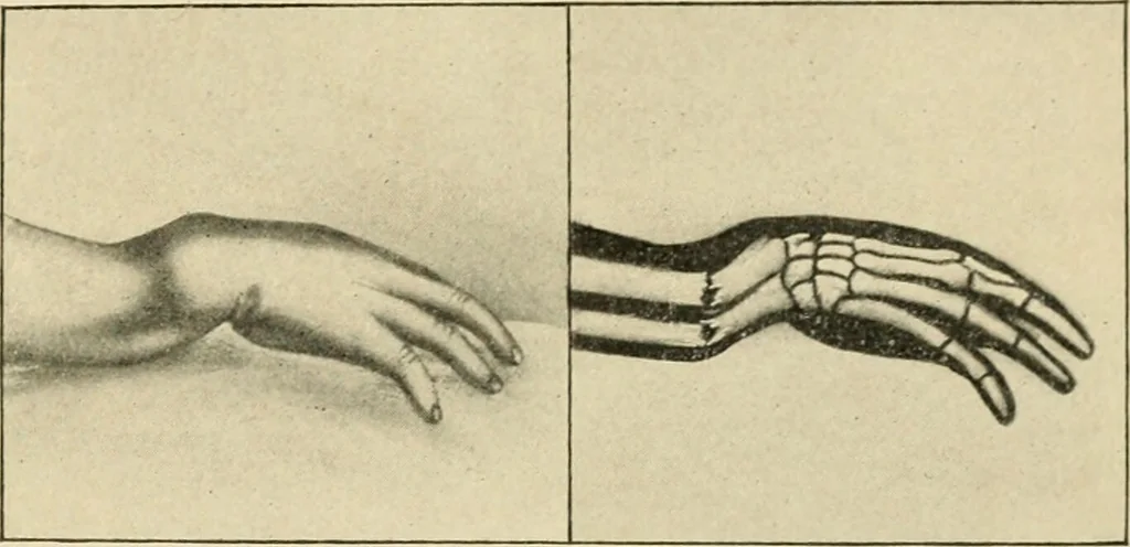 An illustration from The principles and practice of modern surgery / by Roswell Park ... with 722 engravings and 60 full-page plates in colors and monochrome., 1907, leaf 583