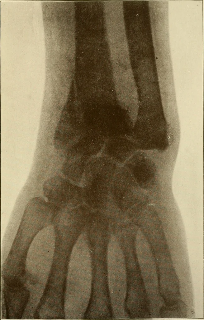 An illustration from The principles and practice of modern surgery / by Roswell Park ... with 722 engravings and 60 full-page plates in colors and monochrome., 1907, leaf 585