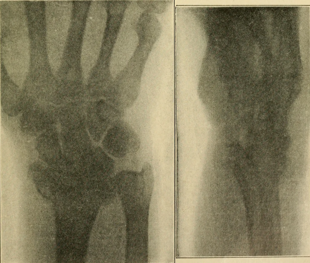 An illustration from The principles and practice of modern surgery / by Roswell Park ... with 722 engravings and 60 full-page plates in colors and monochrome., 1907, leaf 587