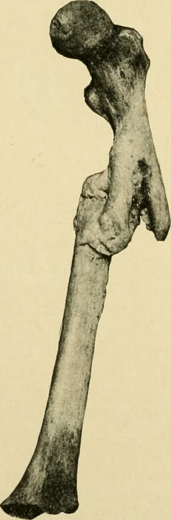 An illustration from The principles and practice of modern surgery / by Roswell Park ... with 722 engravings and 60 full-page plates in colors and monochrome., 1907, leaf 596