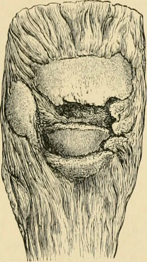 An illustration from The principles and practice of modern surgery / by Roswell Park ... with 722 engravings and 60 full-page plates in colors and monochrome., 1907, leaf 601