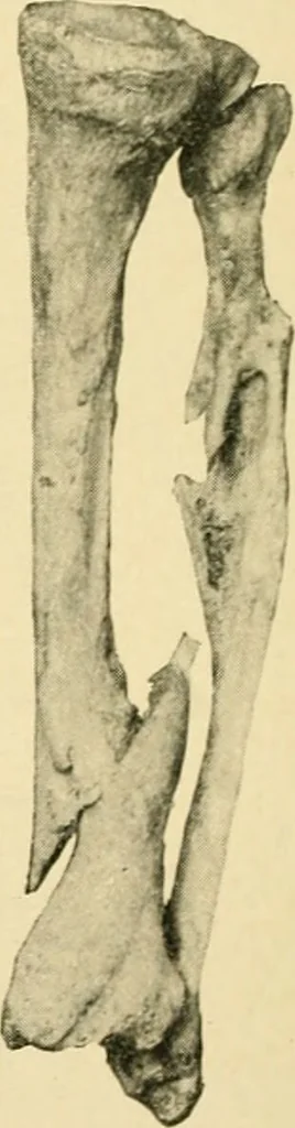 An illustration from The principles and practice of modern surgery / by Roswell Park ... with 722 engravings and 60 full-page plates in colors and monochrome., 1907, leaf 604