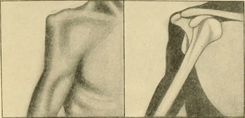 An illustration from The principles and practice of modern surgery / by Roswell Park ... with 722 engravings and 60 full-page plates in colors and monochrome., 1907, leaf 615