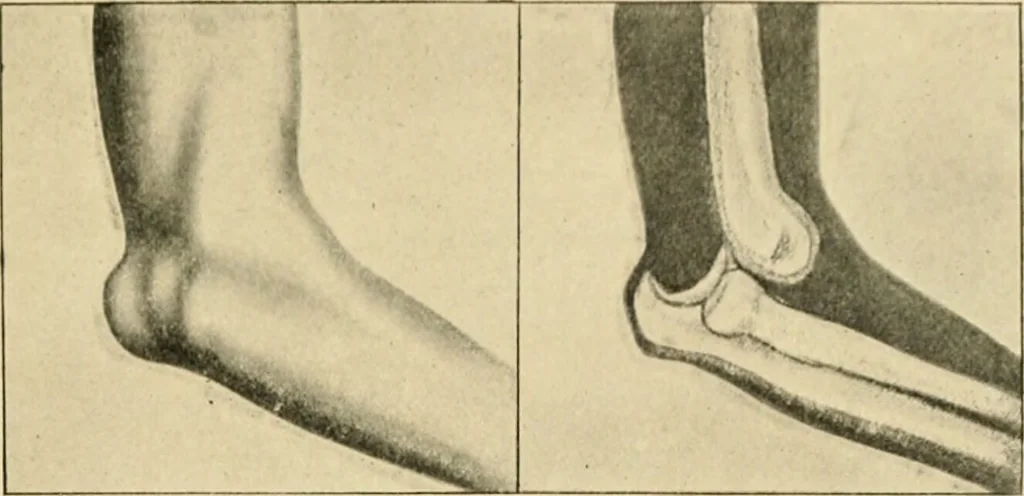 An illustration from The principles and practice of modern surgery / by Roswell Park ... with 722 engravings and 60 full-page plates in colors and monochrome., 1907, leaf 619