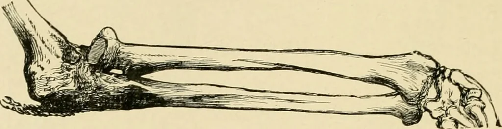 An illustration from The principles and practice of modern surgery / by Roswell Park ... with 722 engravings and 60 full-page plates in colors and monochrome., 1907, leaf 620