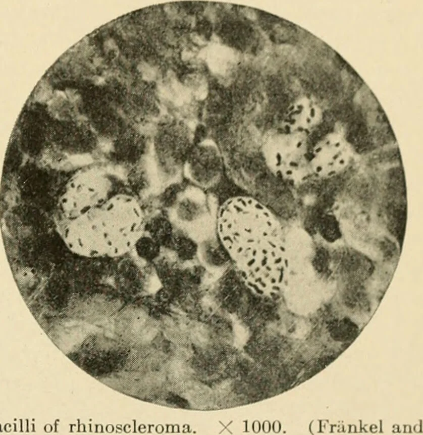 An illustration from The principles and practice of modern surgery / by Roswell Park ... with 722 engravings and 60 full-page plates in colors and monochrome., 1907, leaf 63