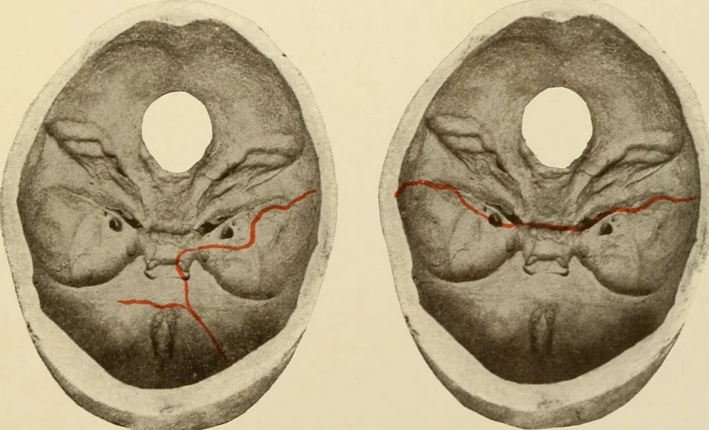 An illustration from The principles and practice of modern surgery / by Roswell Park ... with 722 engravings and 60 full-page plates in colors and monochrome., 1907, leaf 641