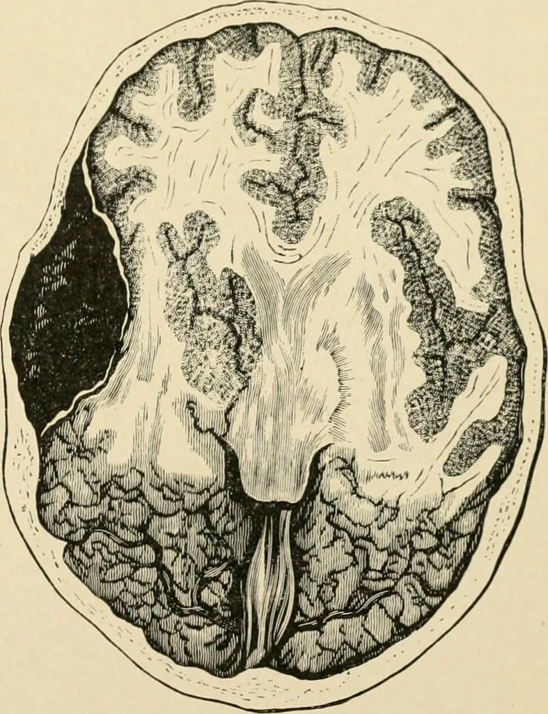 An illustration from The principles and practice of modern surgery / by Roswell Park ... with 722 engravings and 60 full-page plates in colors and monochrome., 1907, leaf 651