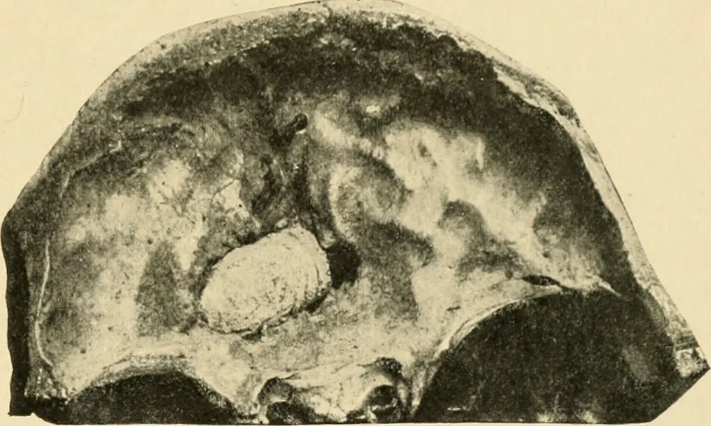 An illustration from The principles and practice of modern surgery / by Roswell Park ... with 722 engravings and 60 full-page plates in colors and monochrome., 1907, leaf 653