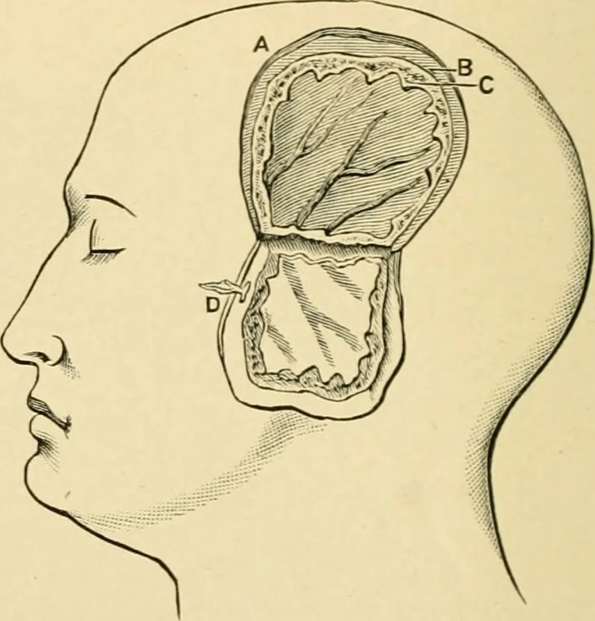 An illustration from The principles and practice of modern surgery / by Roswell Park ... with 722 engravings and 60 full-page plates in colors and monochrome., 1907, leaf 680