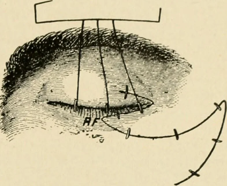An illustration from The principles and practice of modern surgery / by Roswell Park ... with 722 engravings and 60 full-page plates in colors and monochrome., 1907, leaf 695
