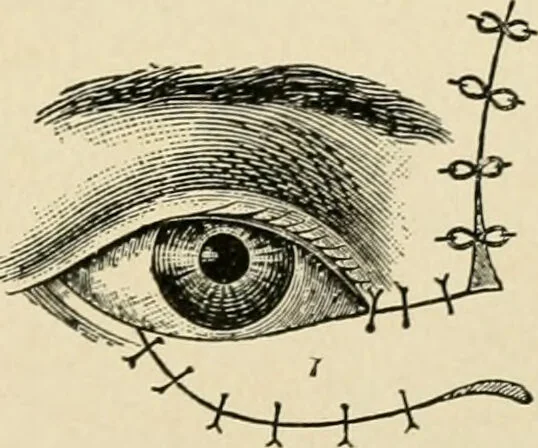 An illustration from The principles and practice of modern surgery / by Roswell Park ... with 722 engravings and 60 full-page plates in colors and monochrome., 1907, leaf 695