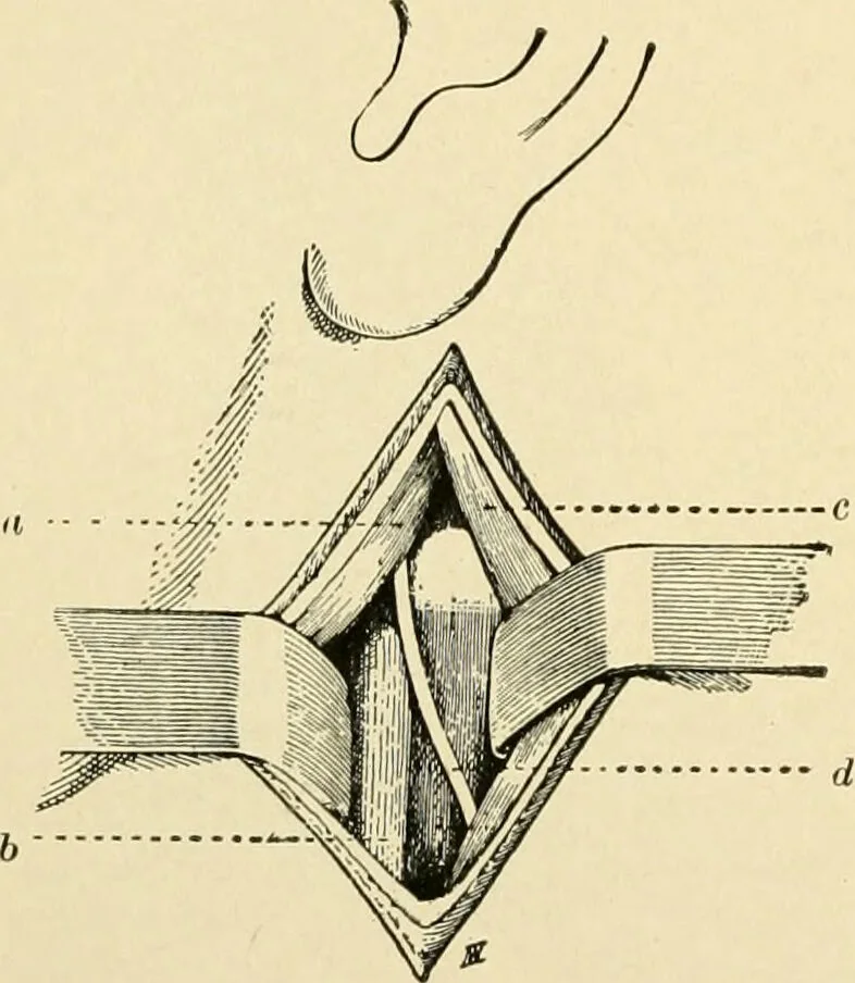 An illustration from The principles and practice of modern surgery / by Roswell Park ... with 722 engravings and 60 full-page plates in colors and monochrome., 1907, leaf 710