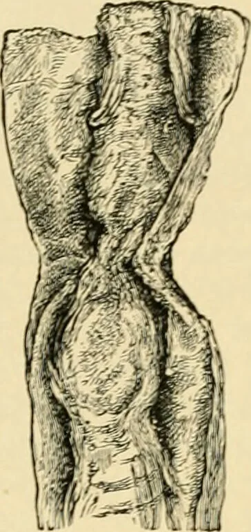 An illustration from The principles and practice of modern surgery / by Roswell Park ... with 722 engravings and 60 full-page plates in colors and monochrome., 1907, leaf 724