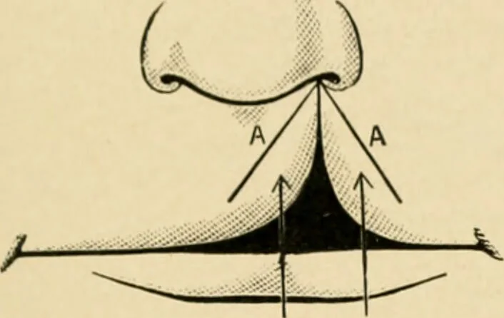 An illustration from The principles and practice of modern surgery / by Roswell Park ... with 722 engravings and 60 full-page plates in colors and monochrome., 1907, leaf 743