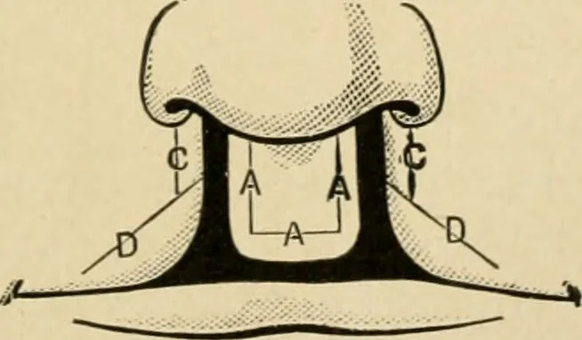 An illustration from The principles and practice of modern surgery / by Roswell Park ... with 722 engravings and 60 full-page plates in colors and monochrome., 1907, leaf 743