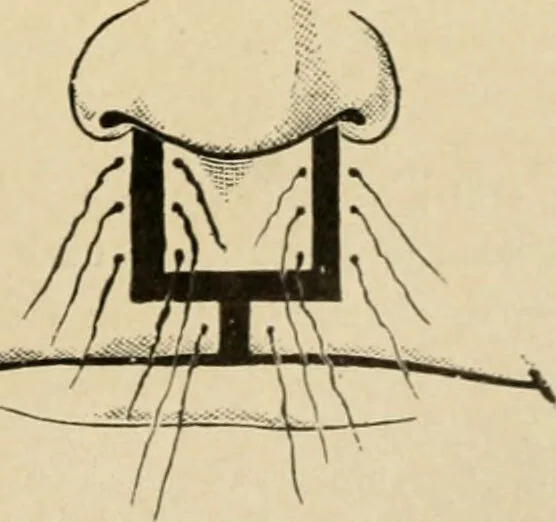 An illustration from The principles and practice of modern surgery / by Roswell Park ... with 722 engravings and 60 full-page plates in colors and monochrome., 1907, leaf 743