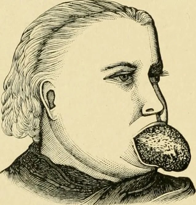 An illustration from The principles and practice of modern surgery / by Roswell Park ... with 722 engravings and 60 full-page plates in colors and monochrome., 1907, leaf 756