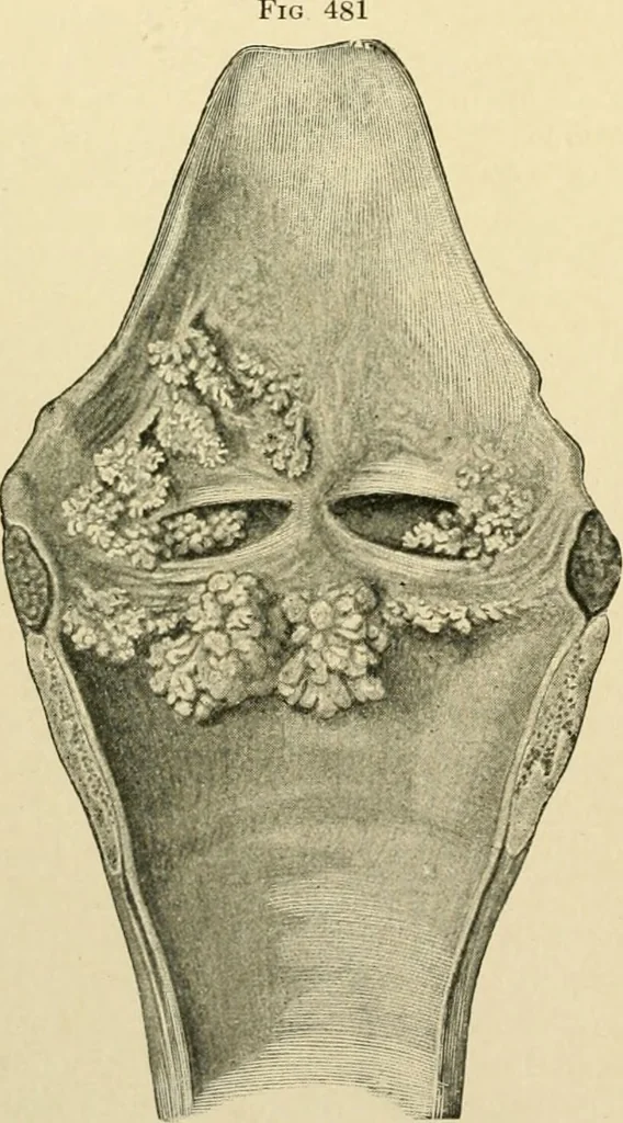 An illustration from The principles and practice of modern surgery / by Roswell Park ... with 722 engravings and 60 full-page plates in colors and monochrome., 1907, leaf 782