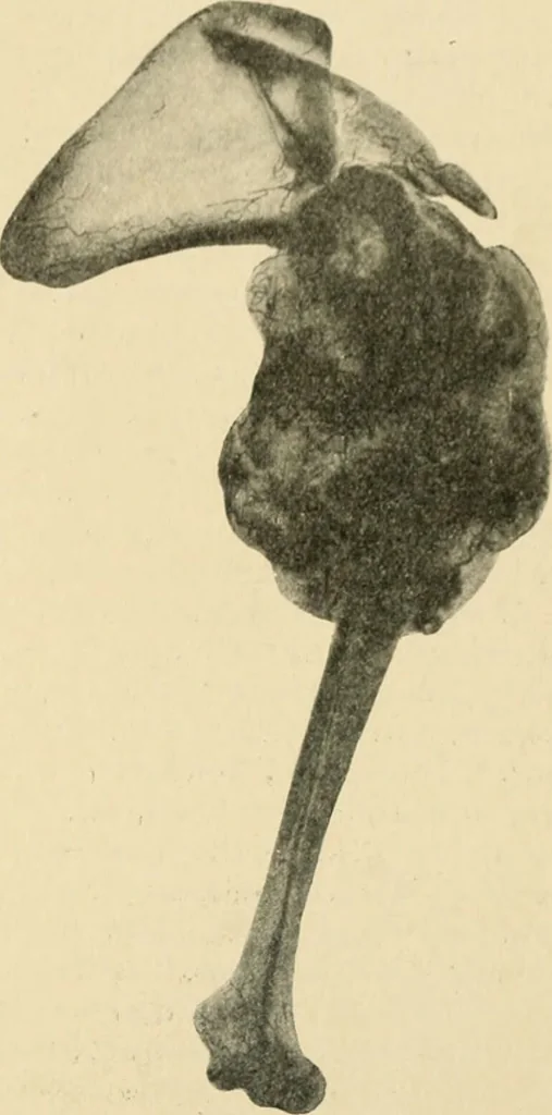 An illustration from The principles and practice of modern surgery / by Roswell Park ... with 722 engravings and 60 full-page plates in colors and monochrome., 1907, leaf 831